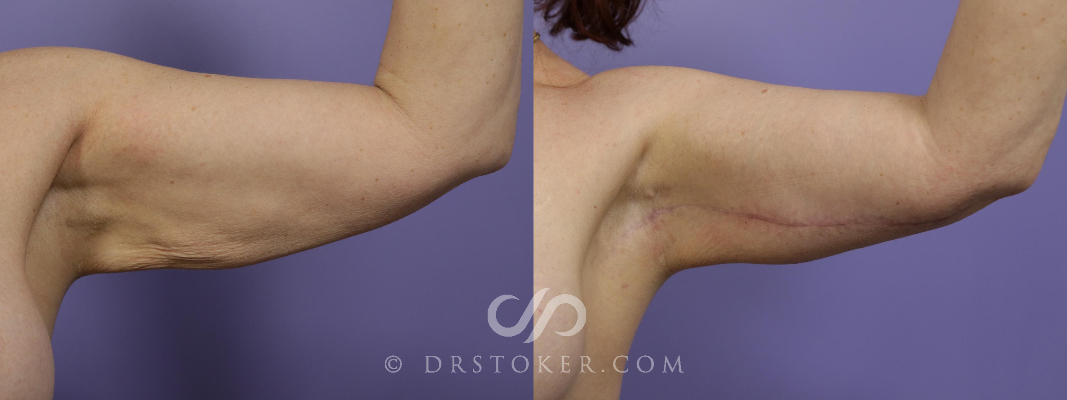 Before & After Arm Lift Case 1378 View #1 View in Los Angeles, CA