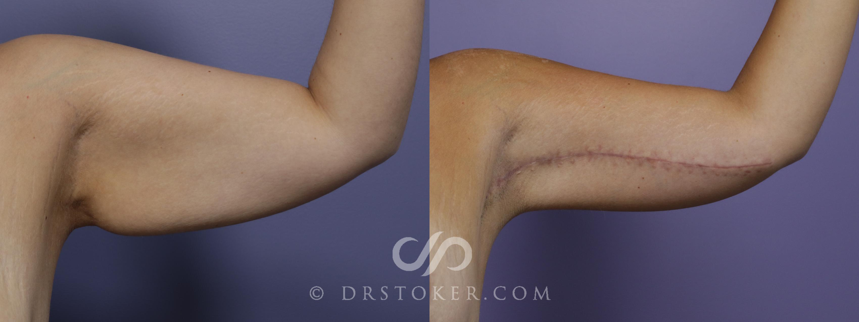 Before & After Arm Lift Case 1391 View #1 View in Los Angeles, CA