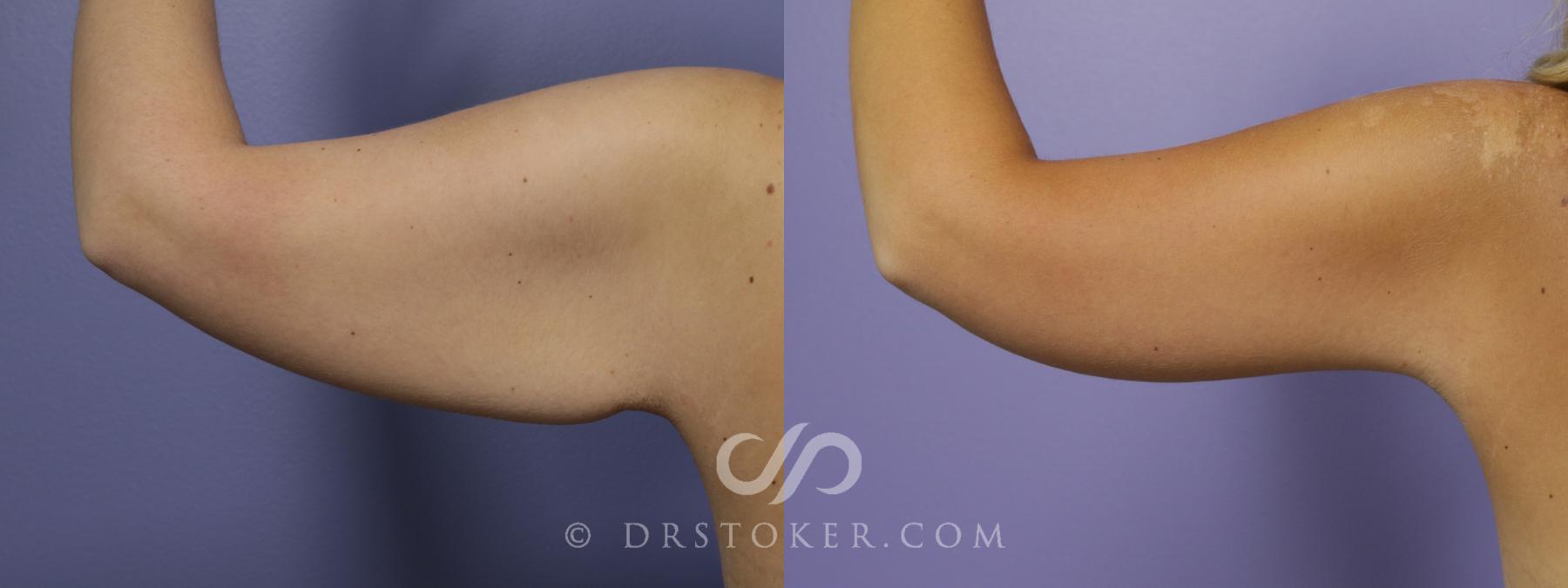 Before & After Arm Lift Case 1392 View #1 View in Los Angeles, CA