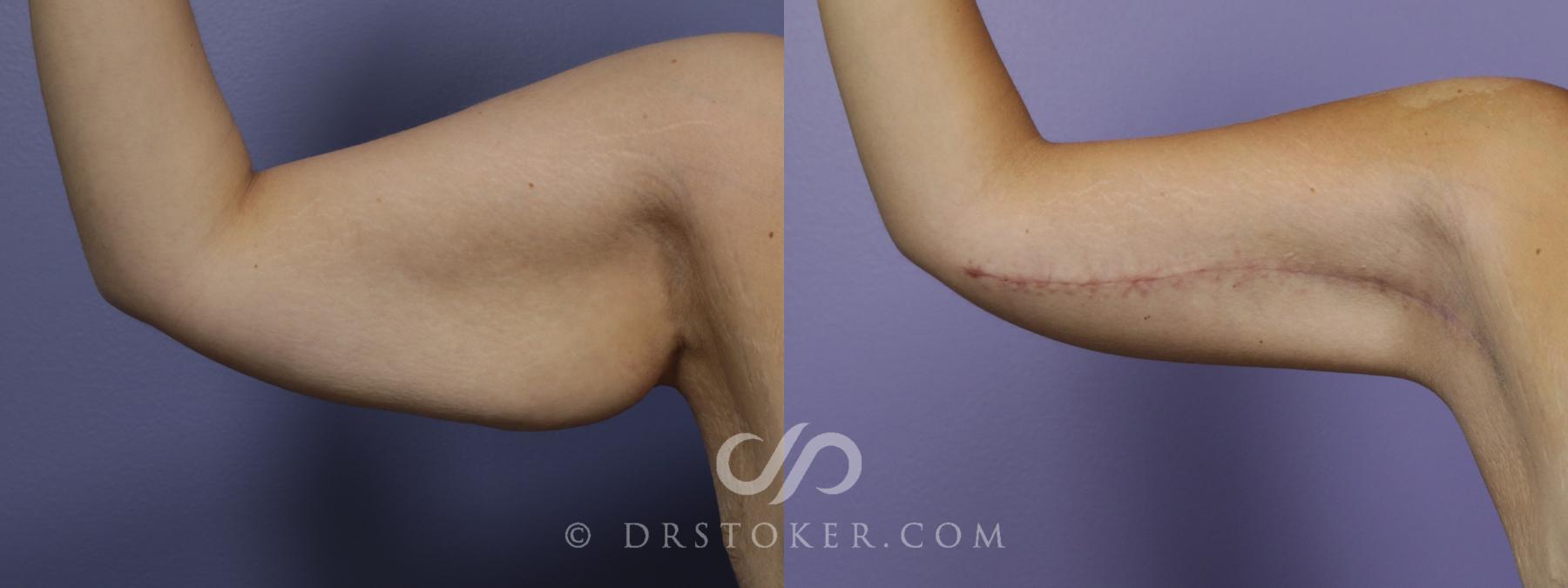 Before & After Arm Lift Case 1393 View #1 View in Los Angeles, CA