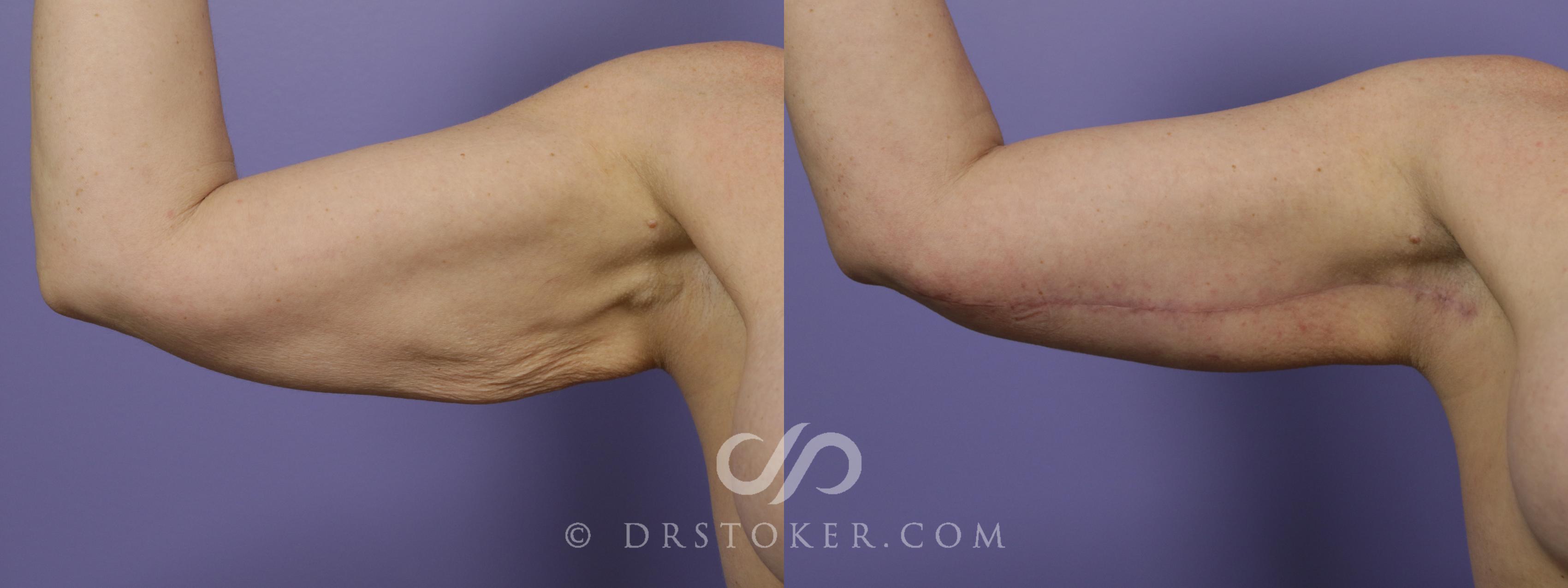 Before & After Arm Lift Case 1394 View #1 View in Los Angeles, CA
