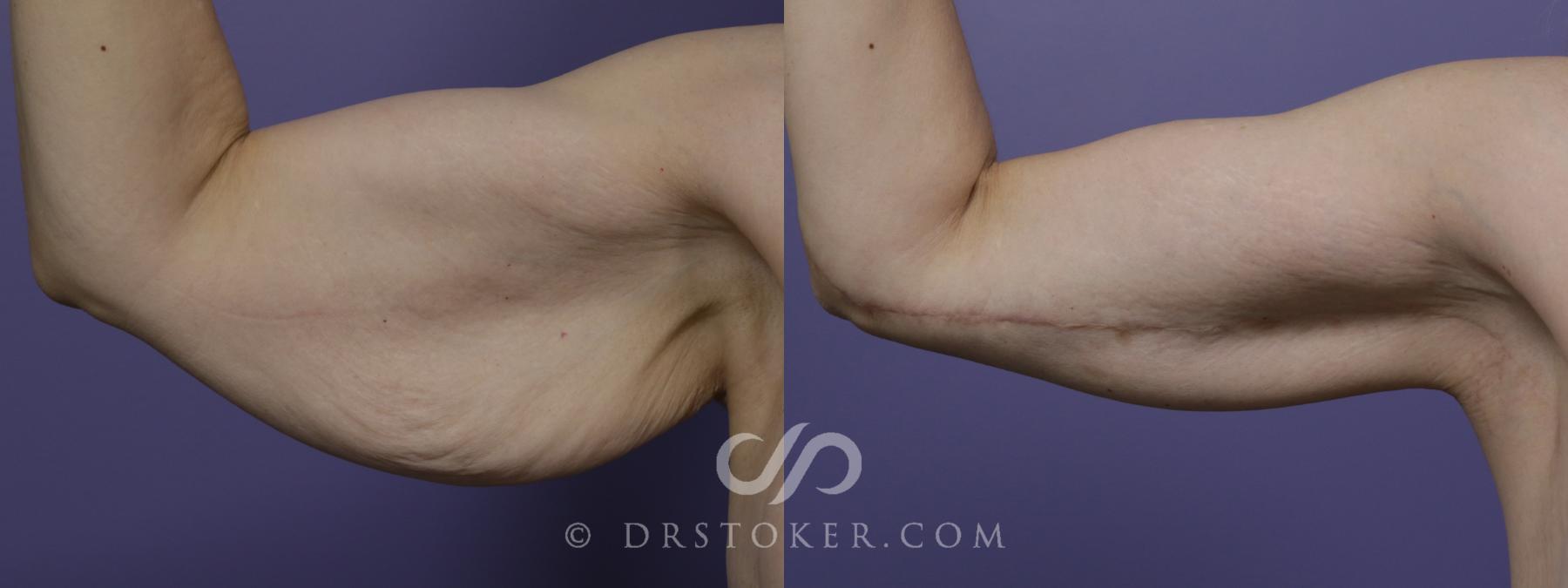 Before & After Arm Lift Case 1472 View #1 View in Los Angeles, CA