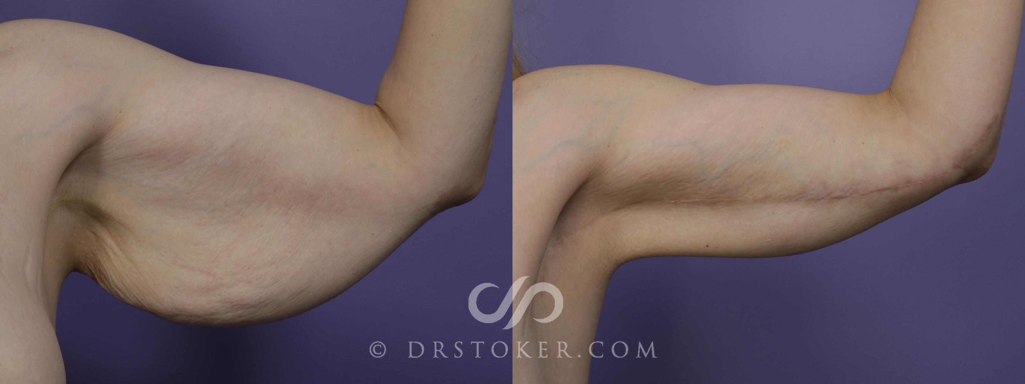Before & After Arm Lift Case 1500 View #1 View in Los Angeles, CA