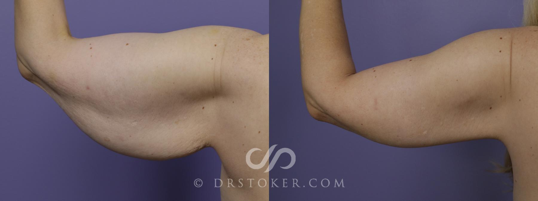 Before & After Arm Lift Case 1501 View #1 View in Los Angeles, CA