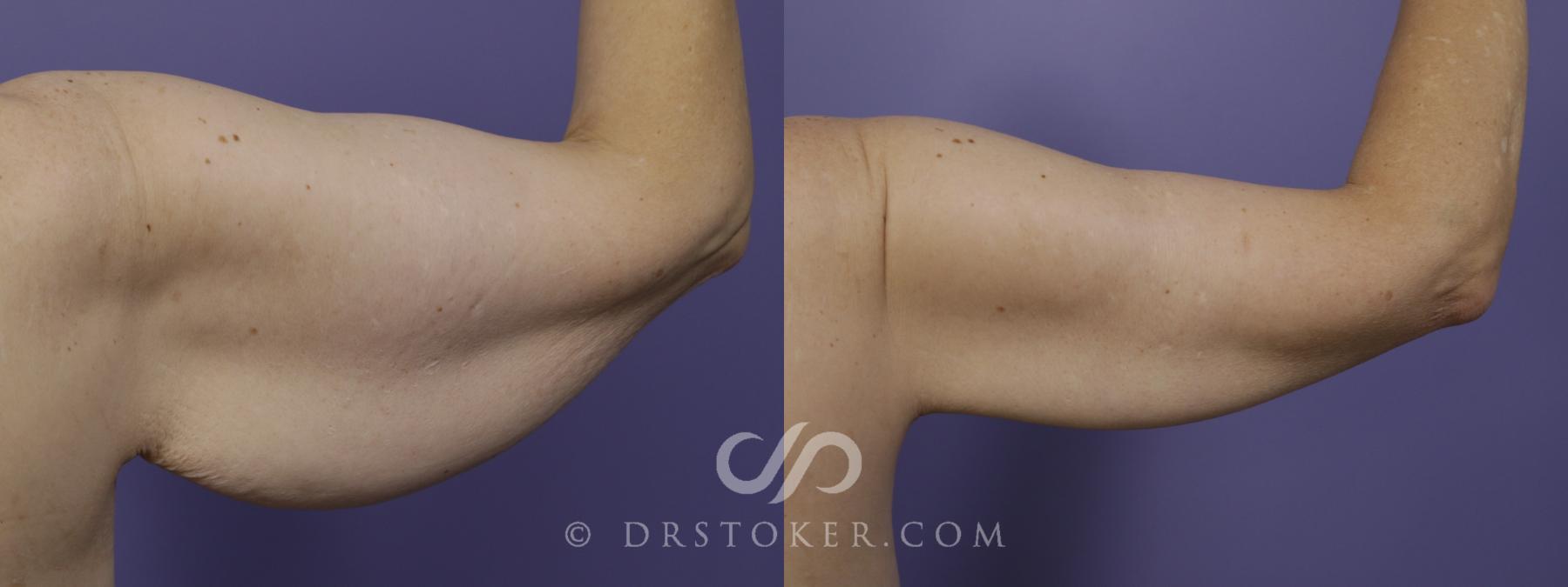 Before & After Arm Lift Case 1502 View #1 View in Los Angeles, CA