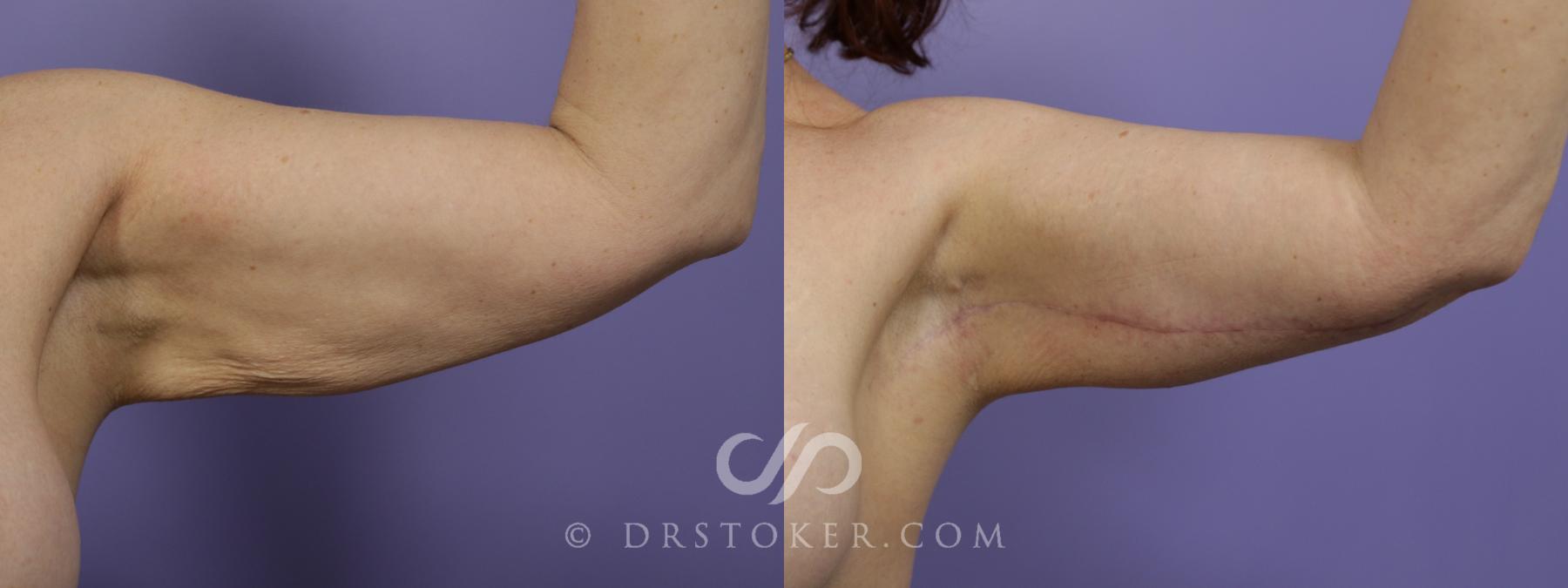 Before & After Arm Lift Case 1504 View #1 View in Los Angeles, CA