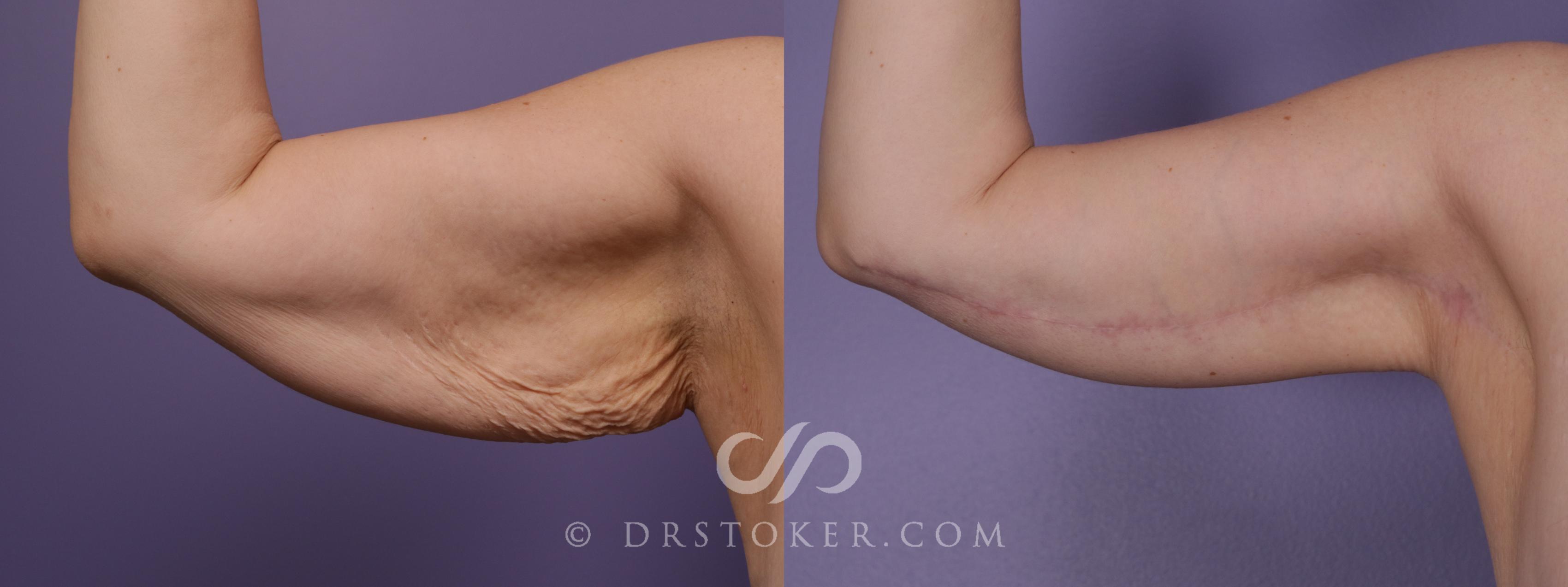 Before & After Arm Lift Case 1817 Left Side View in Los Angeles, CA