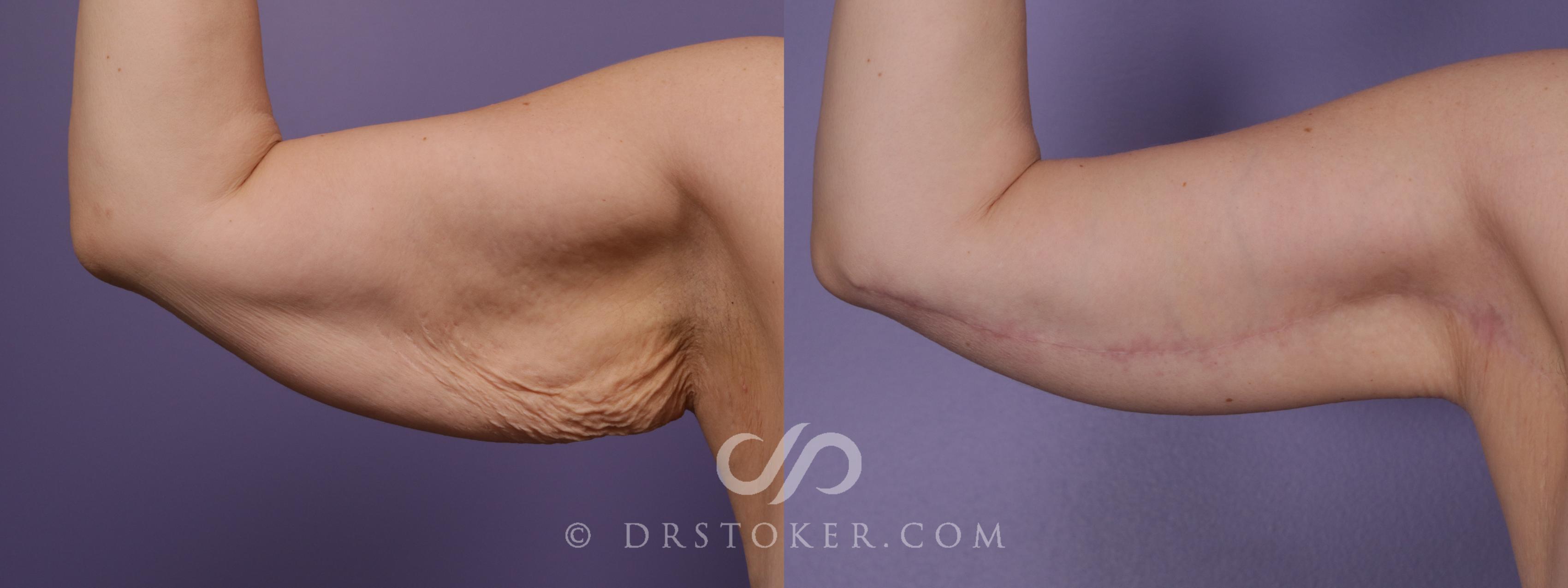 Before & After Arm Lift Case 1819 Right Side View in Los Angeles, CA