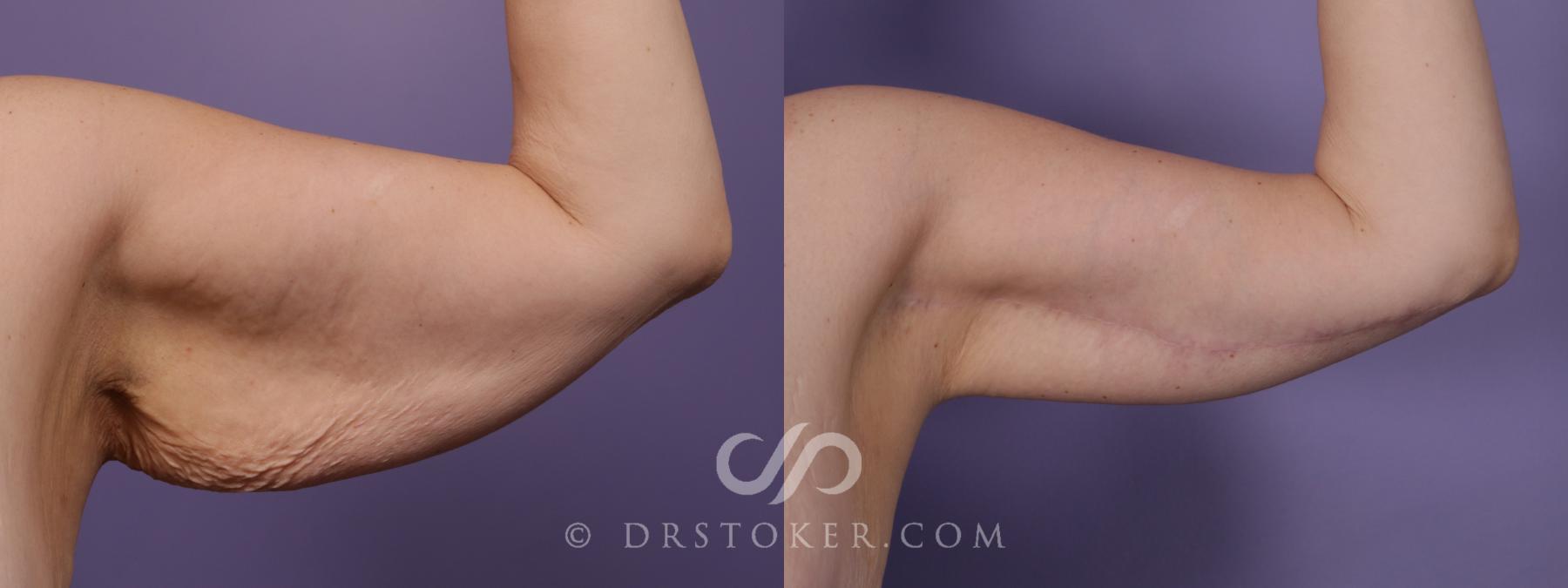 Before & After Arm Lift Case 1820 Left Side View in Los Angeles, CA