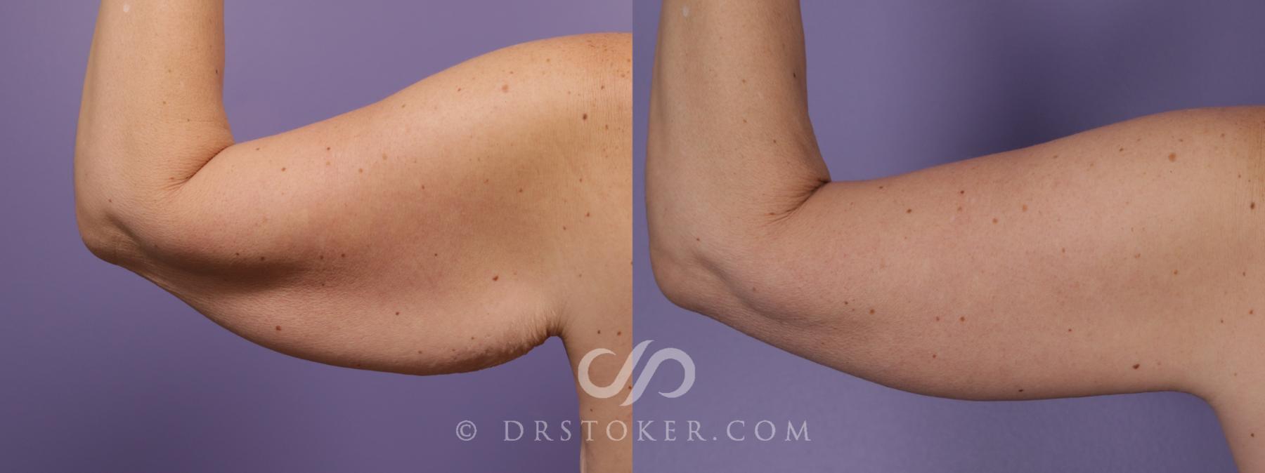 Before & After Arm Lift Case 1821 Outer Left Arm  View in Los Angeles, CA