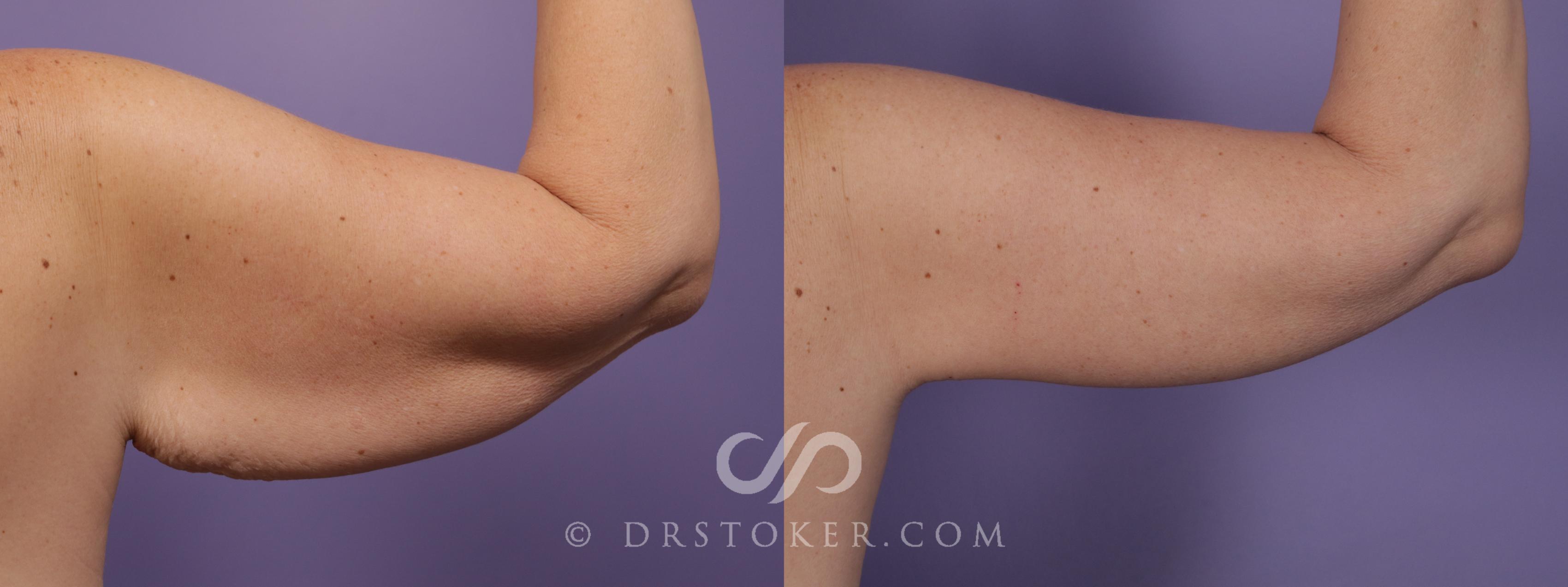 Before & After Arm Lift Case 1822 Outer Right Arm  View in Los Angeles, CA