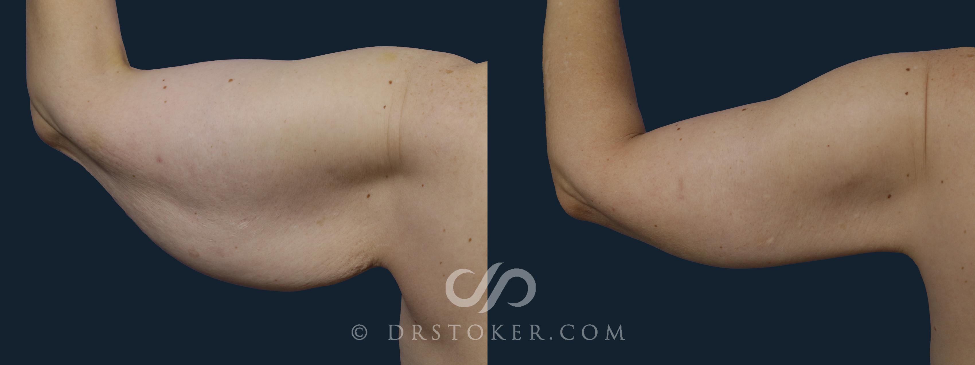 Before & After Arm Lift Case 1936 Left Side View in Los Angeles, CA