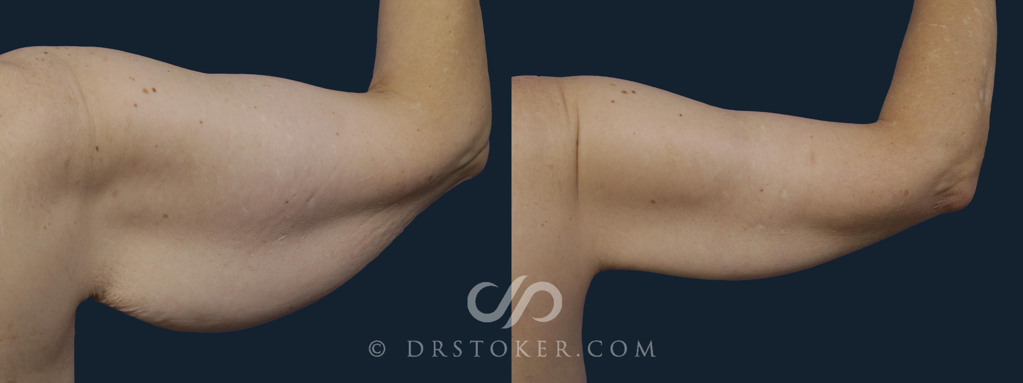 Before & After Arm Lift Case 1937 Right Side View in Los Angeles, CA