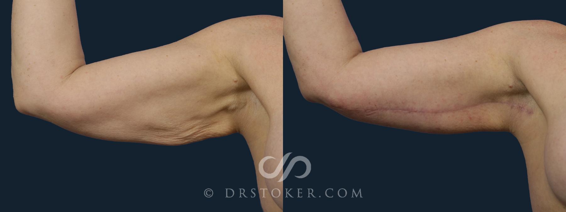 Before & After Arm Lift Case 1987 Right Side View in Los Angeles, CA