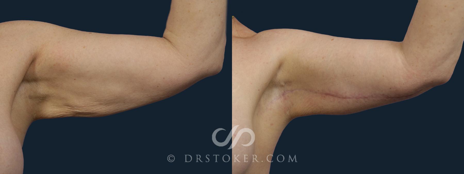 Before & After Arm Lift Case 1988 Left Side View in Los Angeles, CA