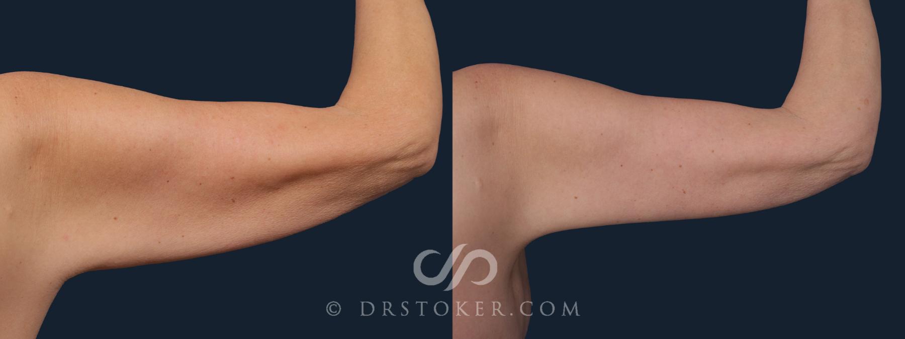 Before & After Arm Lift Case 2215 Right Oblique View in Los Angeles, CA