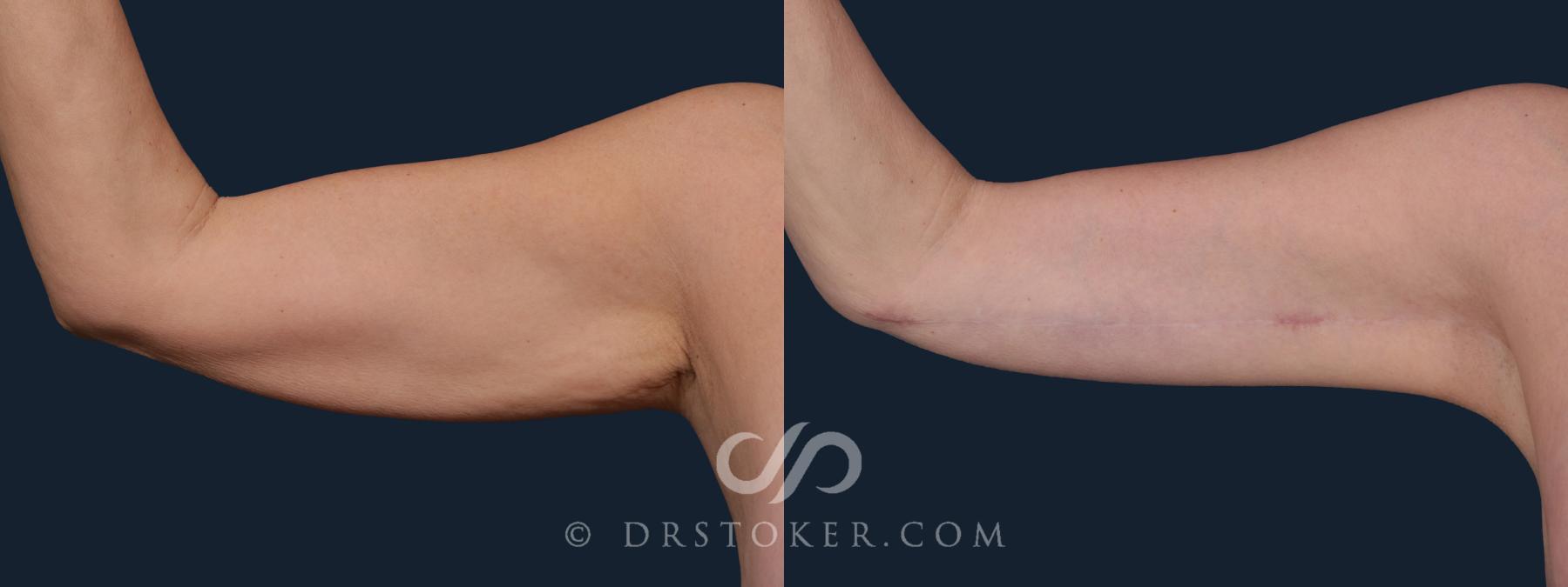 Before & After Arm Lift Case 2215 Right Side View in Los Angeles, CA