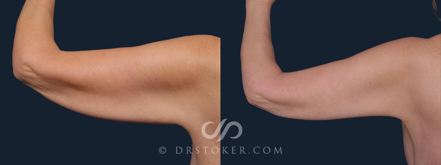 Before & After Arm Lift Case 2216 Left Oblique View in Los Angeles, CA