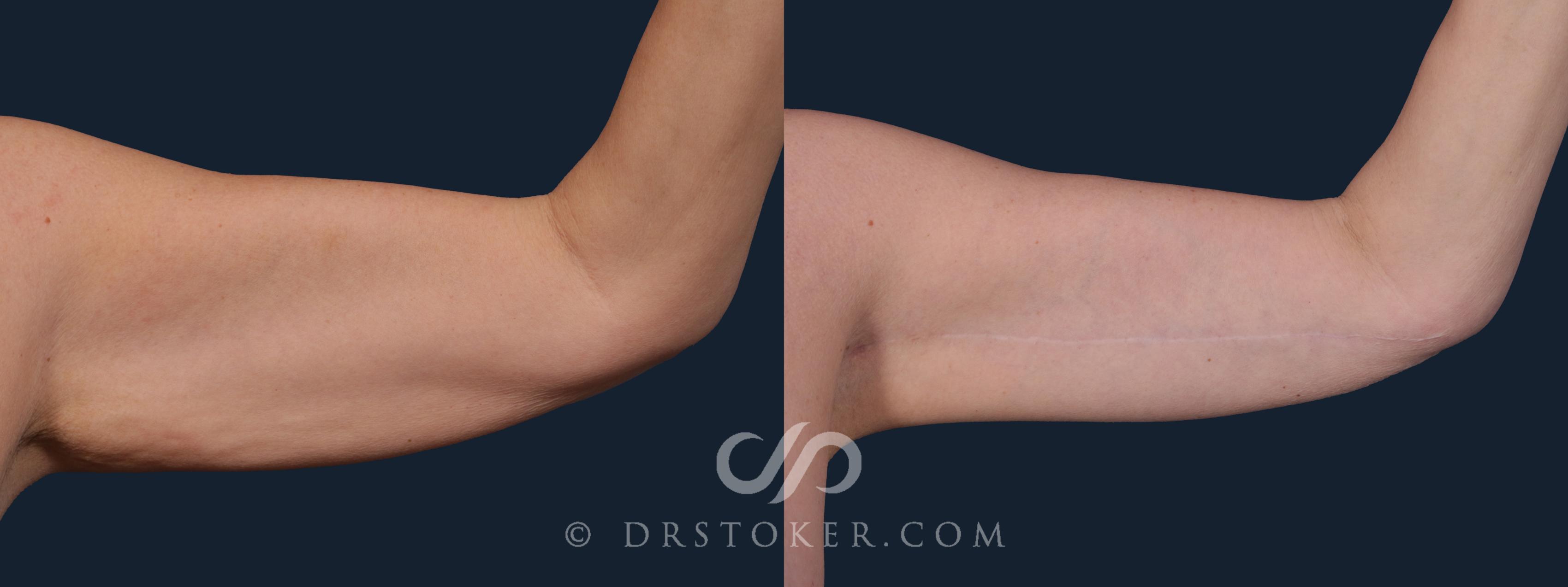 Before & After Arm Lift Case 2216 Left Side View in Los Angeles, CA