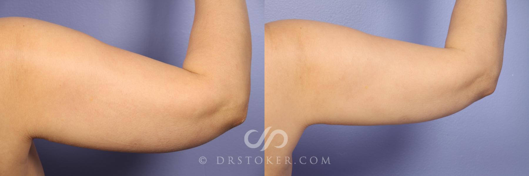 Before & After Arm Lift Case 414 View #1 View in Los Angeles, CA