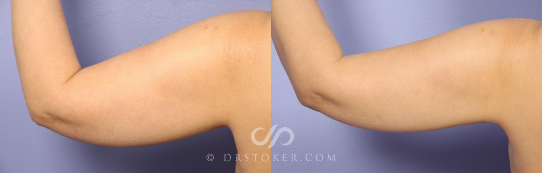 Before & After Arm Lift Case 414 View #2 View in Los Angeles, CA