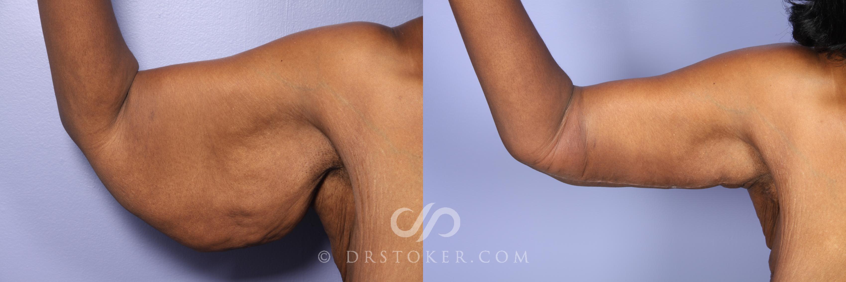 Before & After Arm Lift Case 476 View #1 View in Marina del Rey, CA