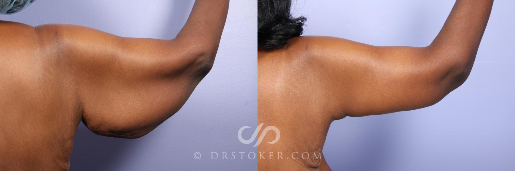 Before & After Arm Lift Case 476 View #3 View in Los Angeles, CA