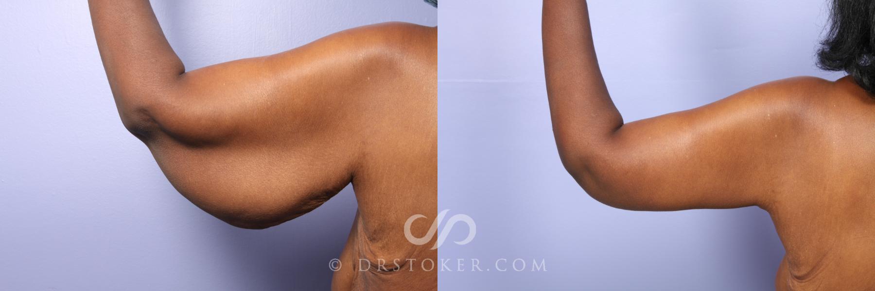 Before & After Arm Lift Case 476 View #4 View in Los Angeles, CA