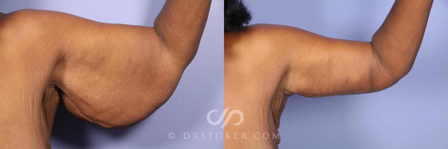 Before & After Arm Lift Case 476 View #5 View in Los Angeles, CA