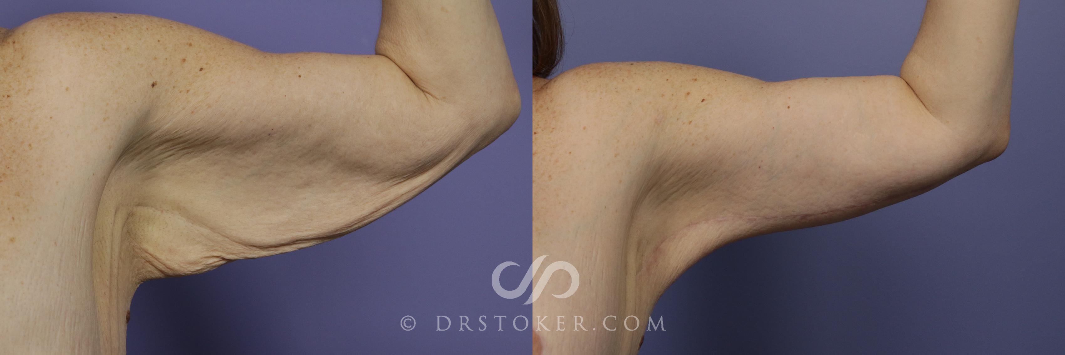 Before & After Arm Lift Case 684 View #1 View in Marina del Rey, CA