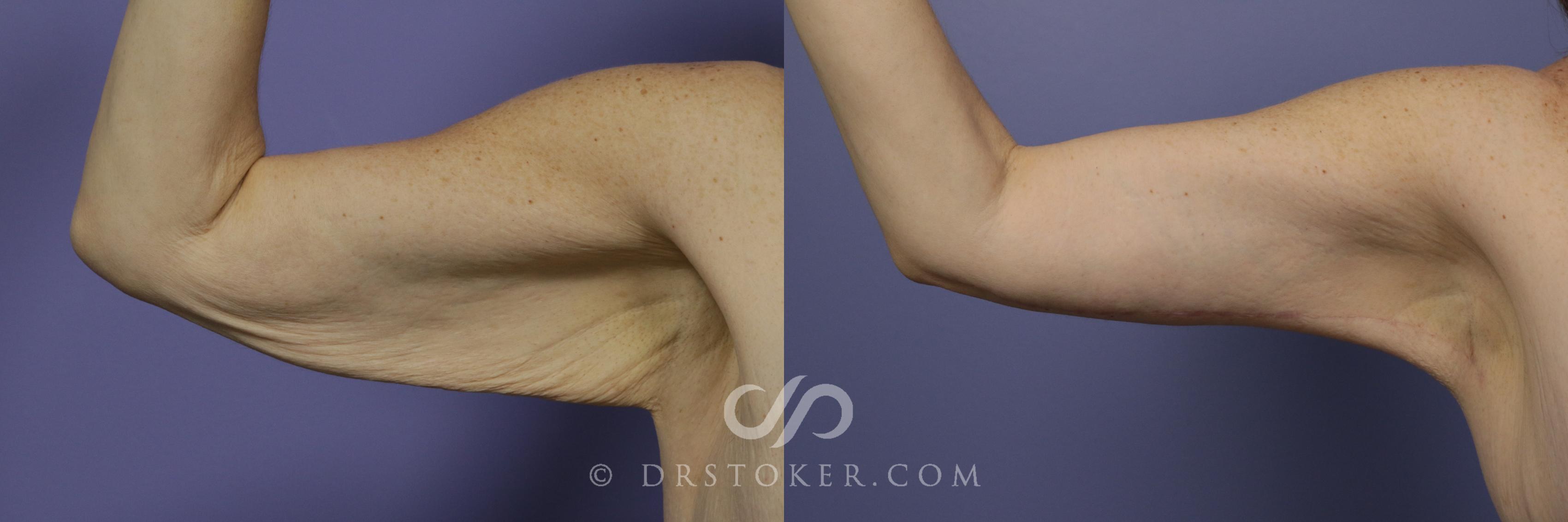 Before & After Arm Lift Case 685 View #1 View in Marina del Rey, CA