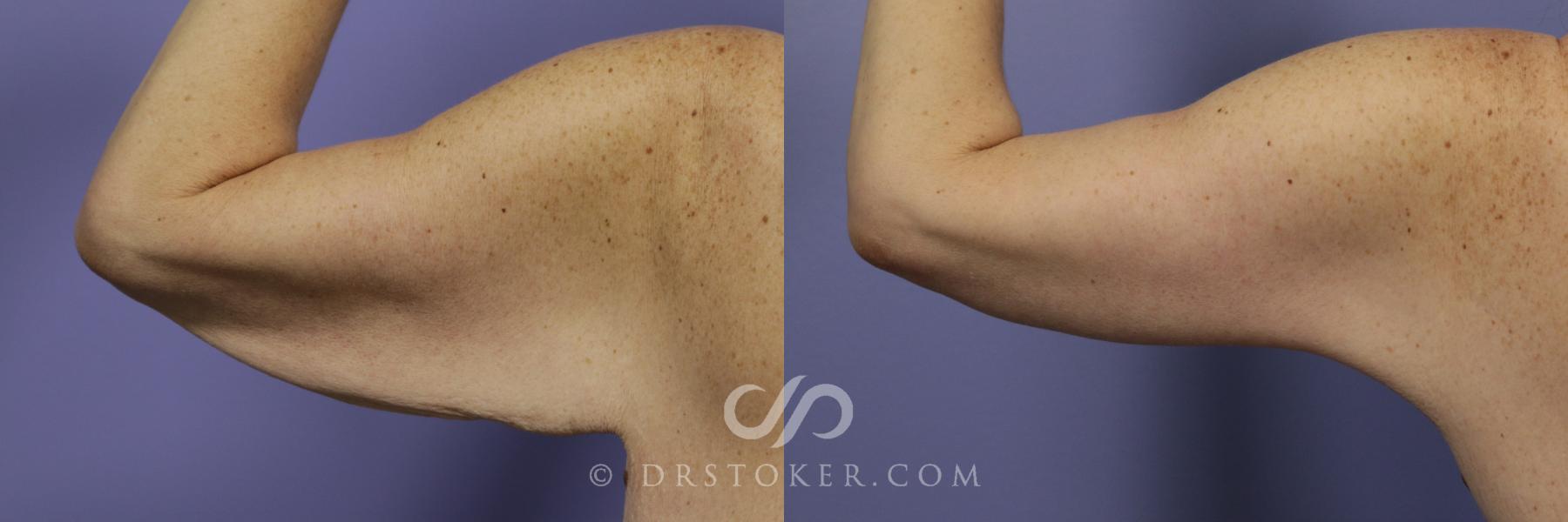 Before & After Arm Lift Case 686 View #1 View in Los Angeles, CA