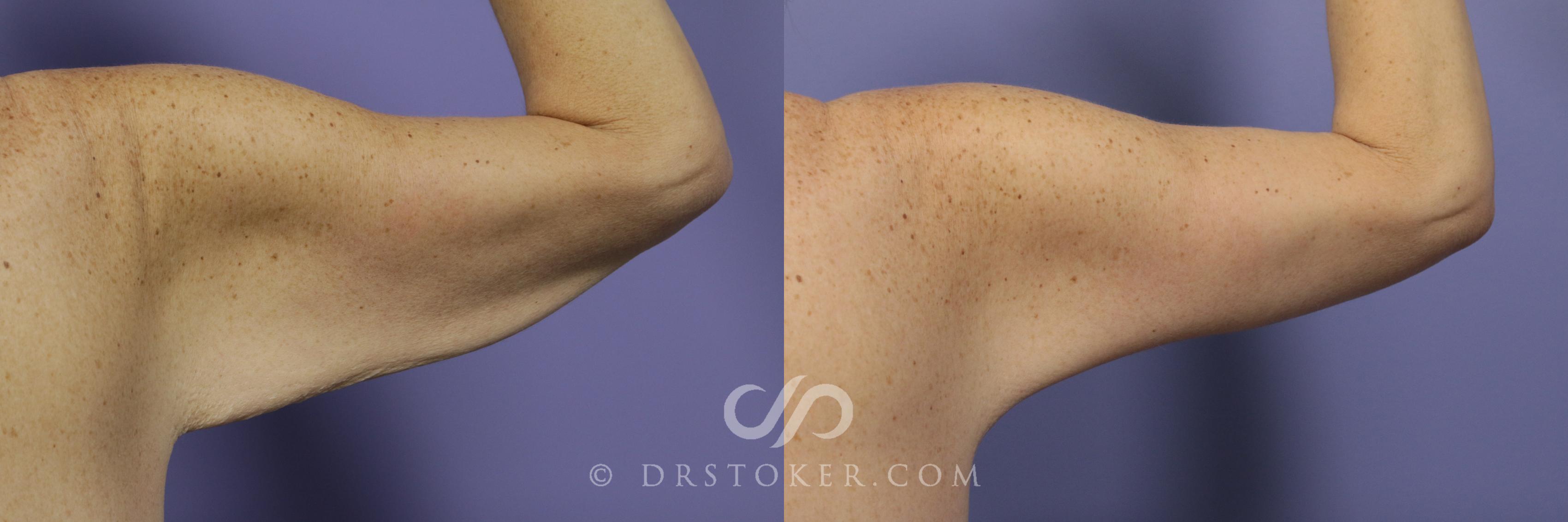 Before & After Arm Lift Case 687 View #1 View in Los Angeles, CA