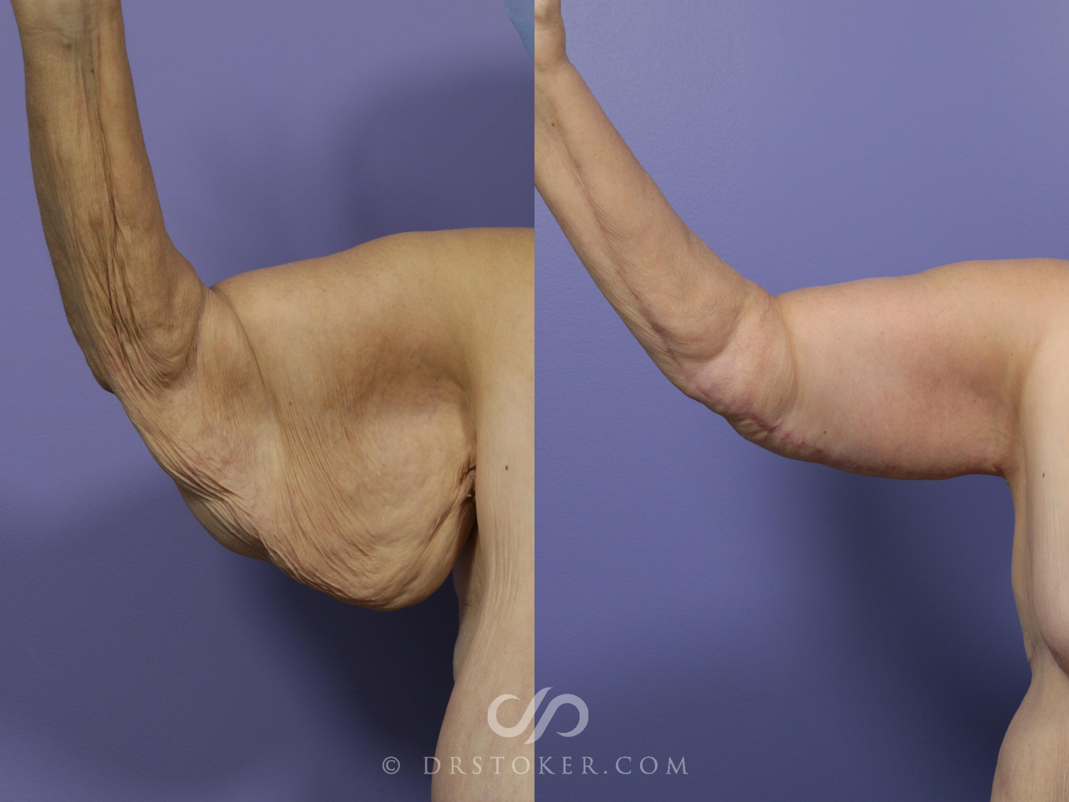 Before & After Arm Lift Case 688 View #1 View in Marina del Rey, CA