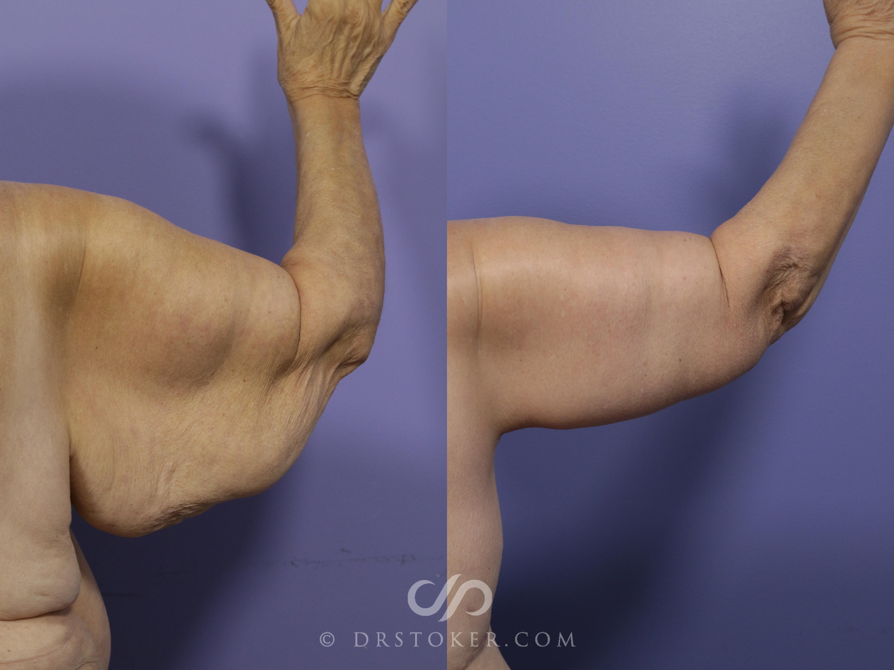 Before & After Arm Lift Case 690 View #1 View in Los Angeles, CA