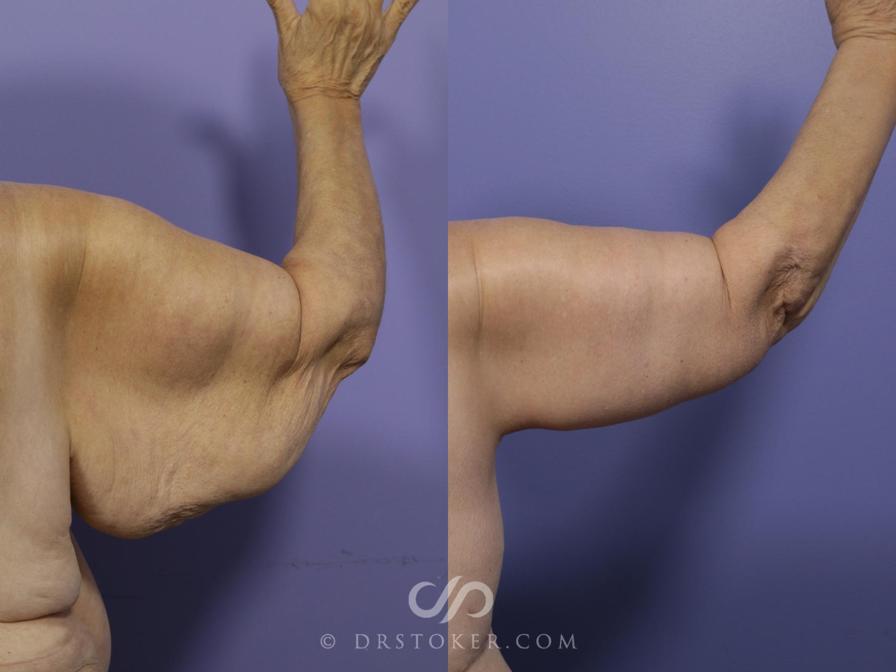 Before & After Arm Lift Case 690 View #1 View in Los Angeles, CA