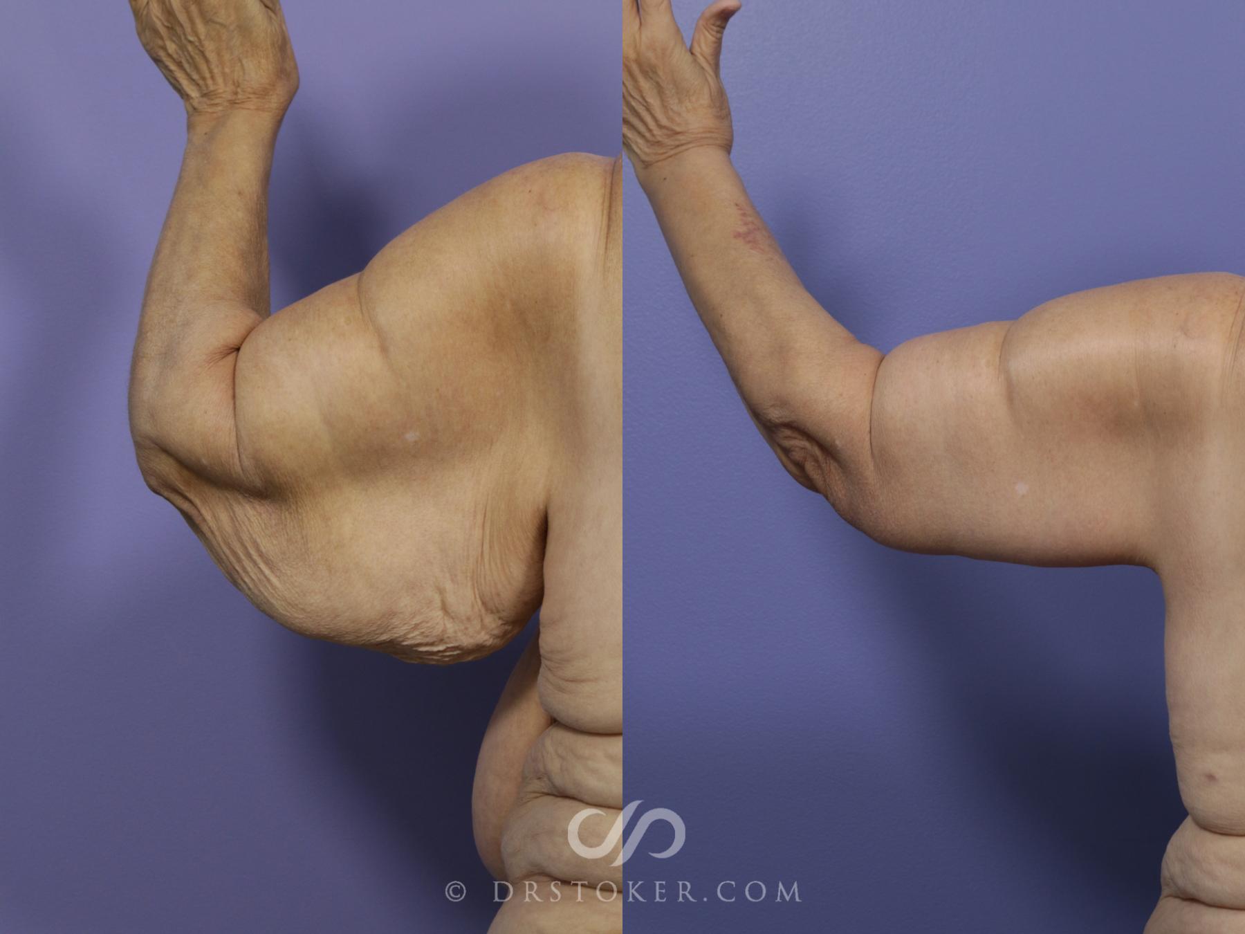A before and after view of a successful brachioplasty procedure