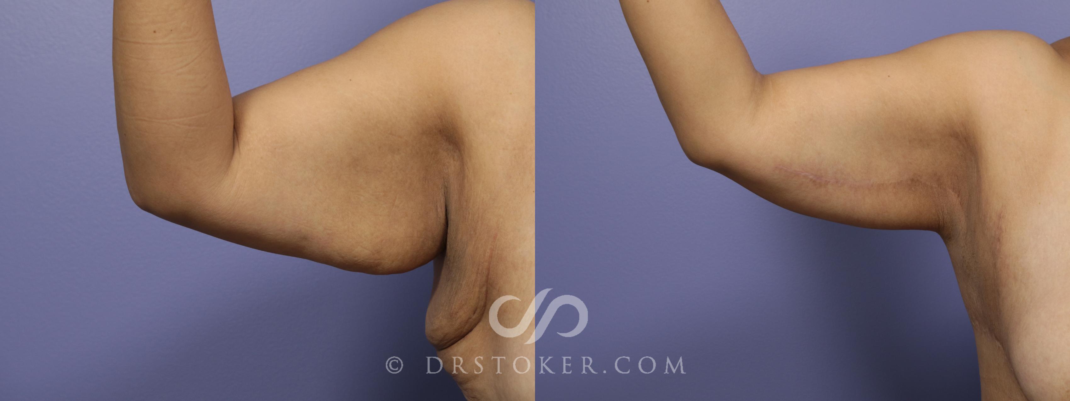 Before & After Arm Lift Case 692 View #1 View in Marina del Rey, CA