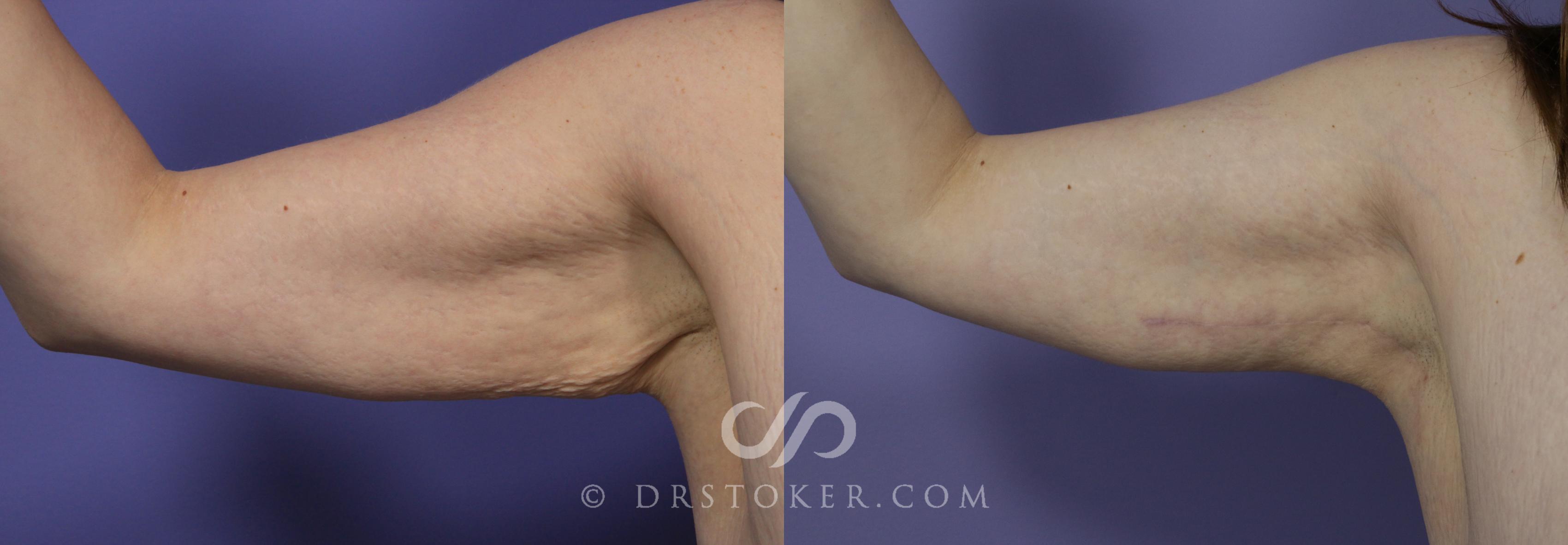 Before & After Arm Lift Case 699 View #1 View in Los Angeles, CA