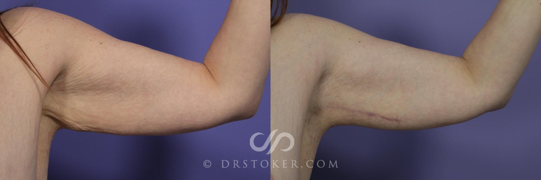Before & After Arm Lift Case 700 View #1 View in Los Angeles, CA