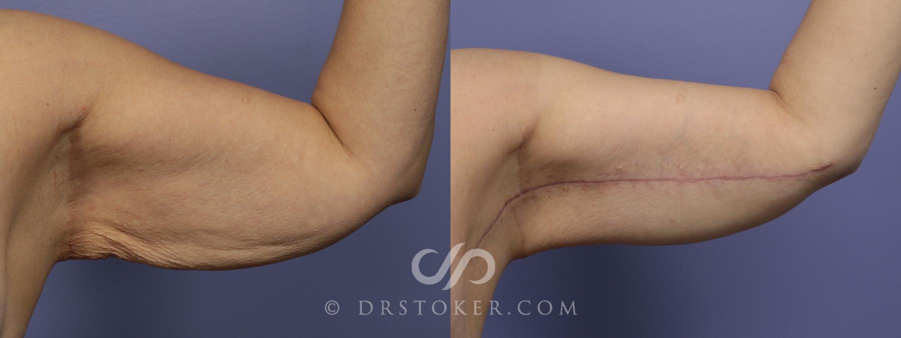 Before & After Arm Lift Case 701 View #1 View in Los Angeles, CA