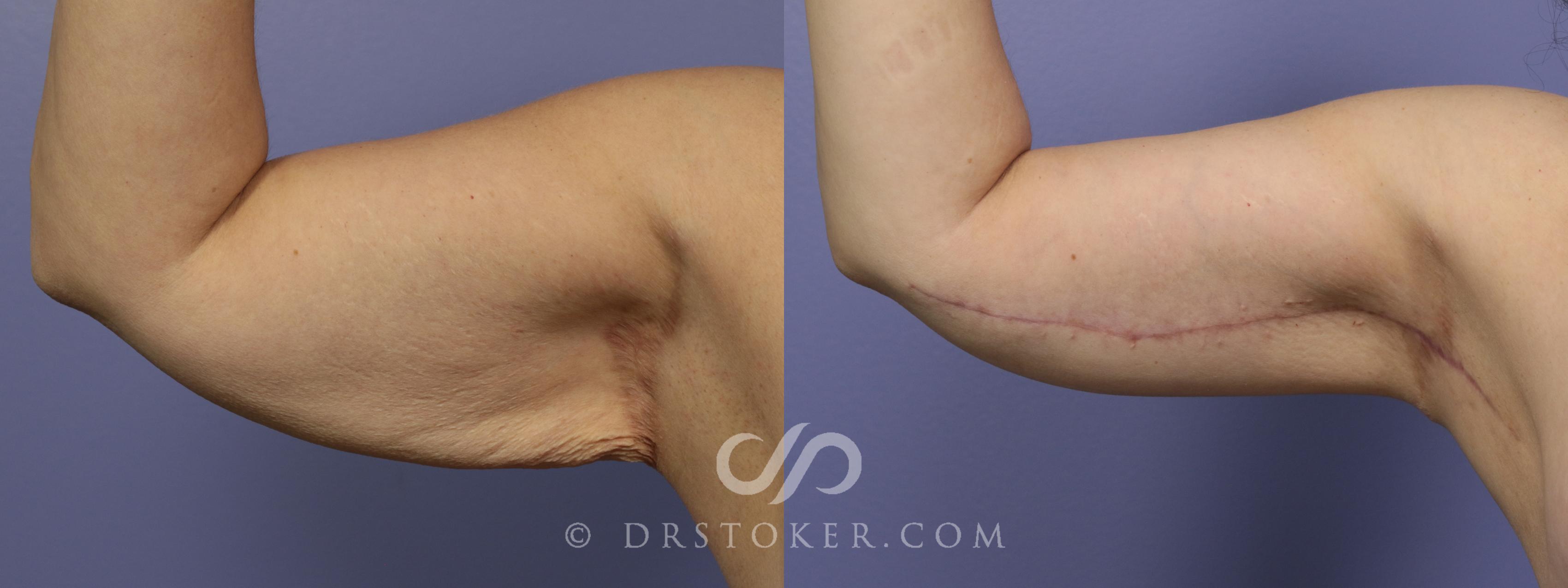Before & After Arm Lift Case 702 View #1 View in Los Angeles, CA