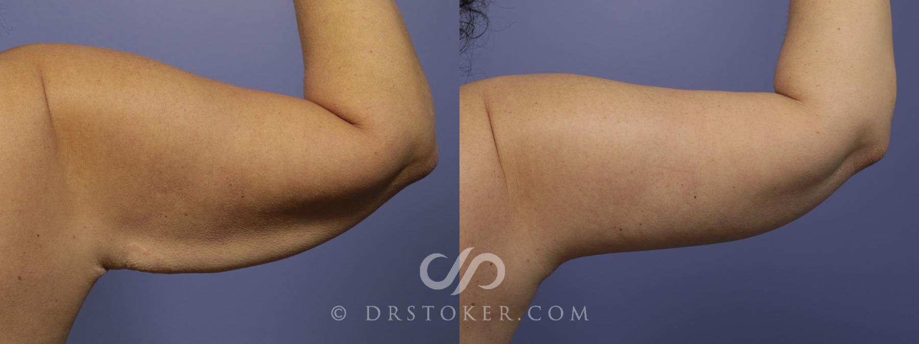 Before & After Arm Lift Case 703 View #1 View in Los Angeles, CA