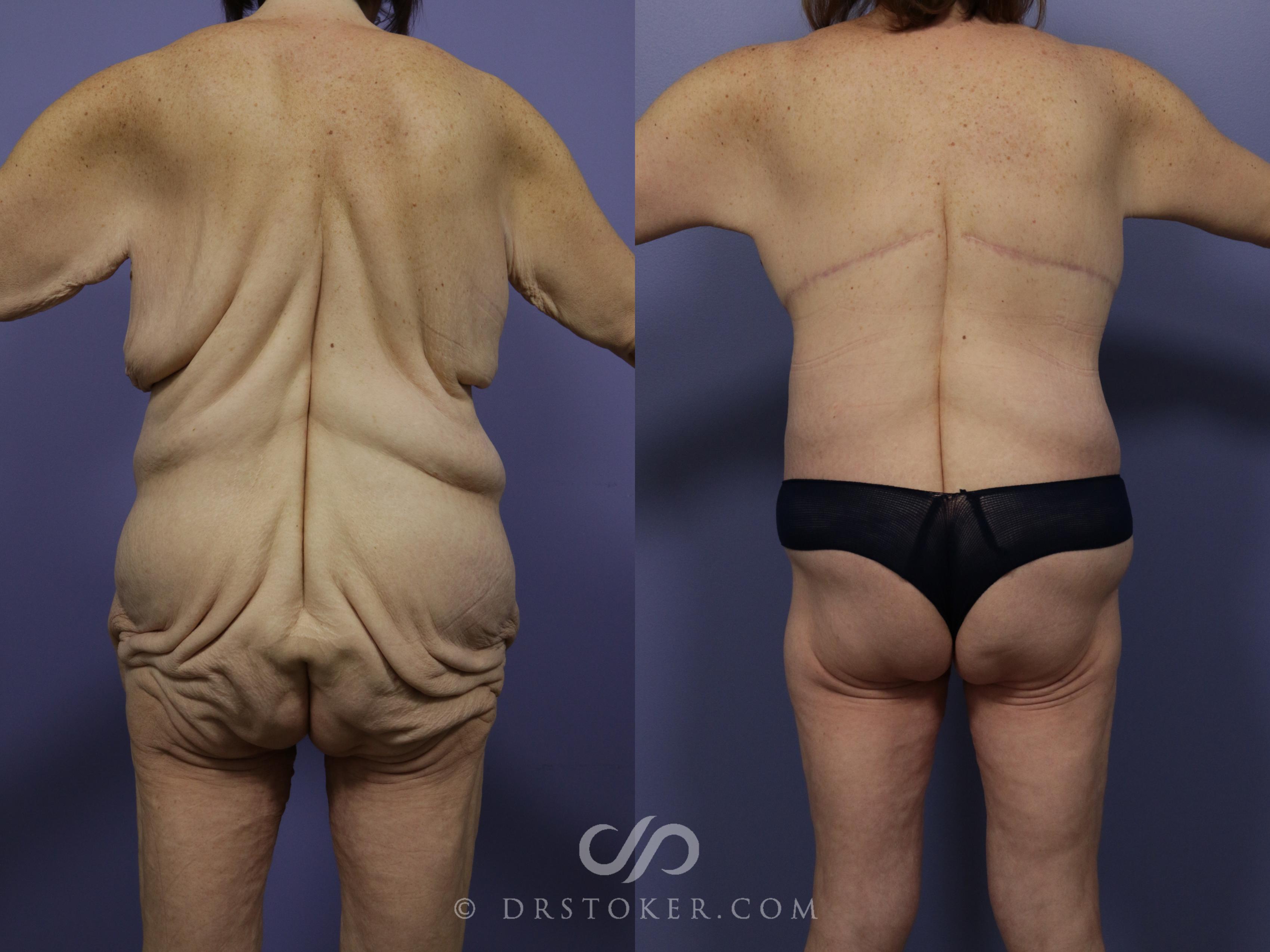 Before & After Back Lift (Bra Line Back Lift) Case 1088 View #1 View in Los Angeles, CA