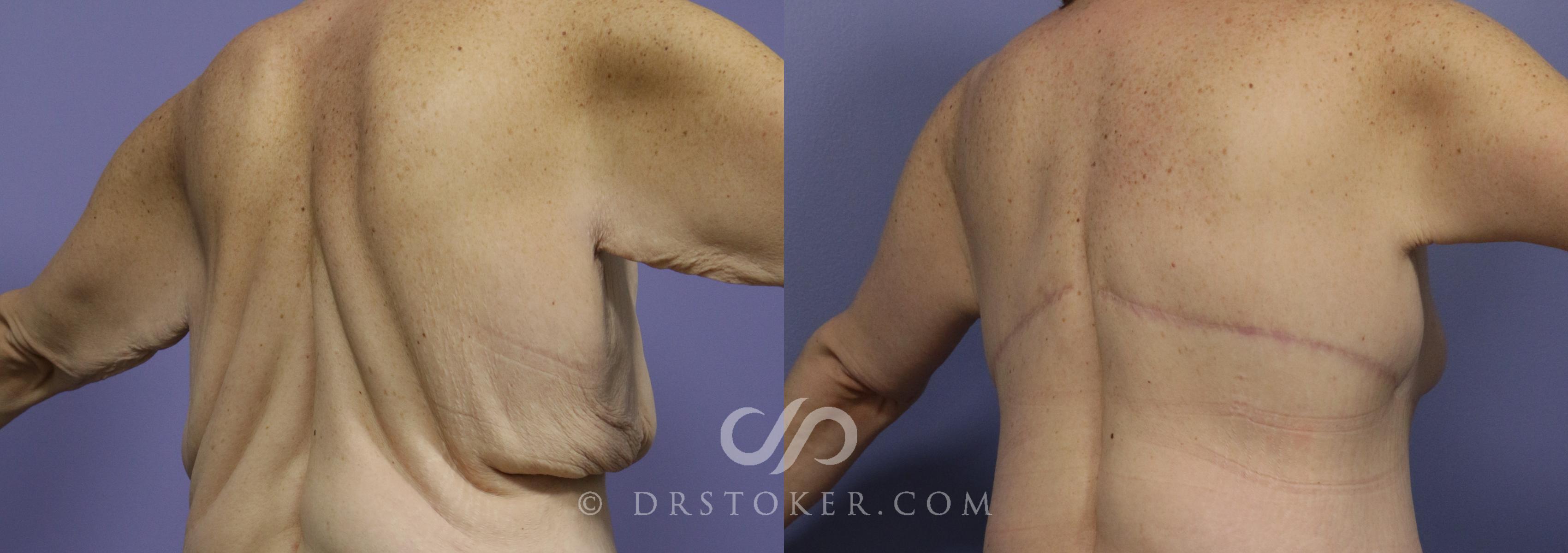 Before & After Back Lift (Bra Line Back Lift) Case 1089 View #1 View in Marina del Rey, CA