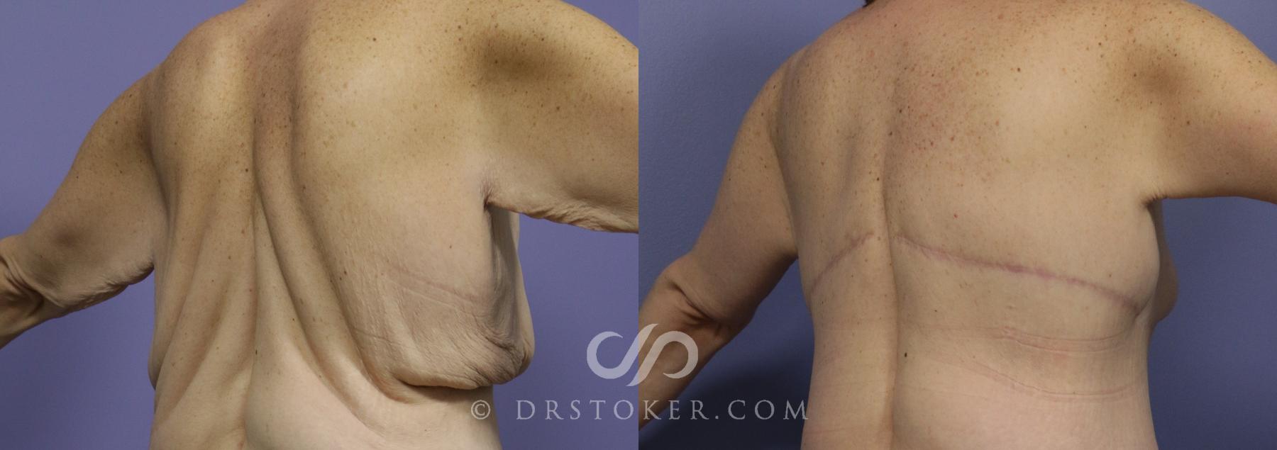 Before & After Back Lift (Bra Line Back Lift) Case 1089 View #1 View in Los Angeles, CA