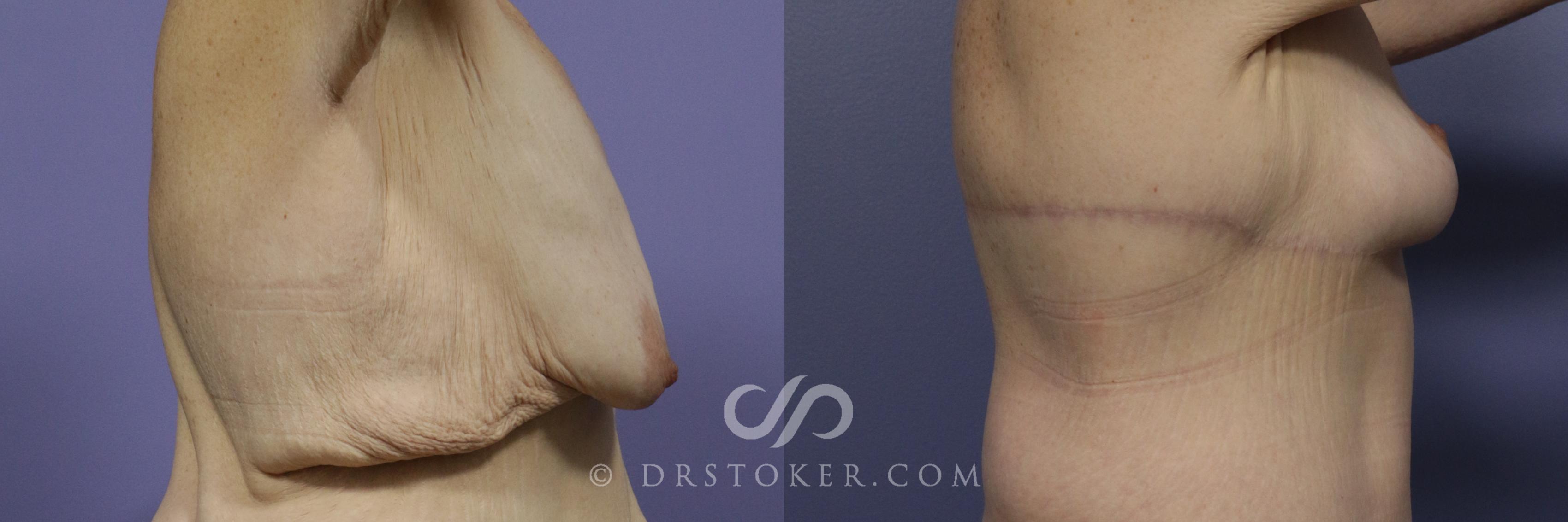 Before & After Back Lift (Bra Line Back Lift) Case 1089 View #2 View in Los Angeles, CA