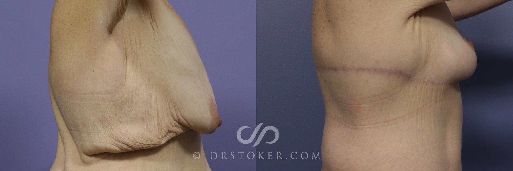 Before & After Back Lift (Bra Line Back Lift) Case 1089 View #2 View in Los Angeles, CA