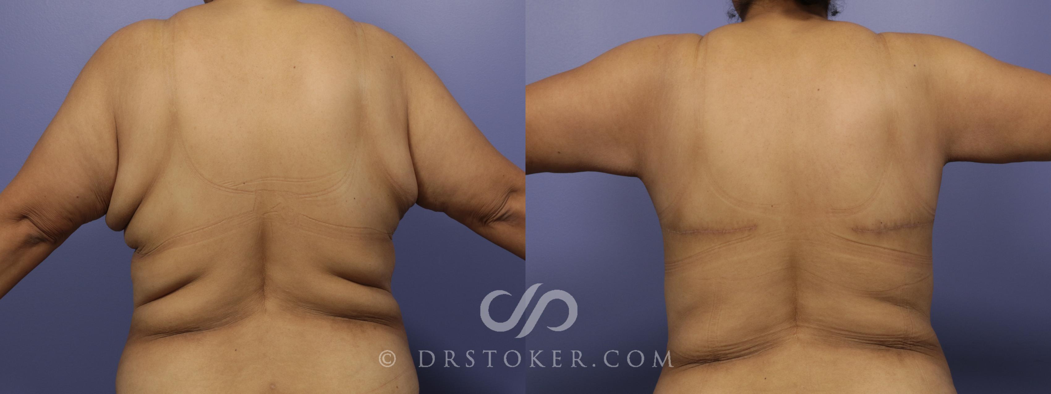 Before & After Back Lift (Bra Line Back Lift) Case 1090 View #1 View in Los Angeles, CA