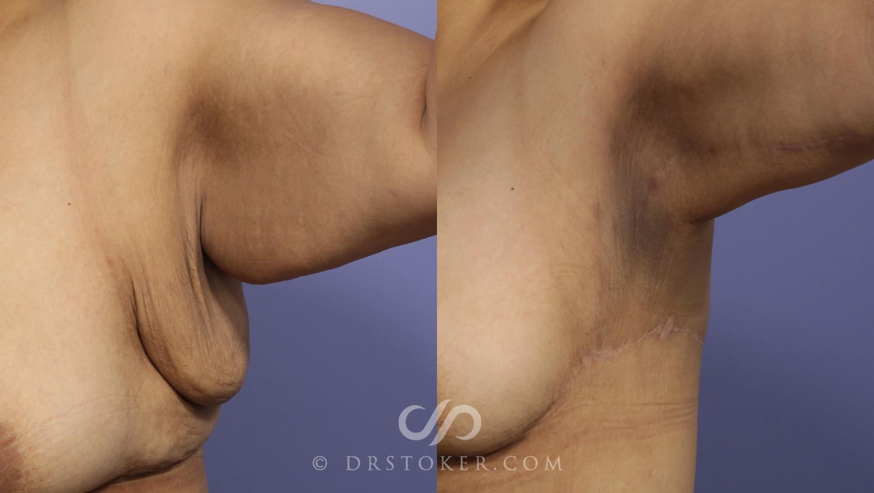 Before & After Back Lift (Bra Line Back Lift) Case 1091 View #1 View in Los Angeles, CA
